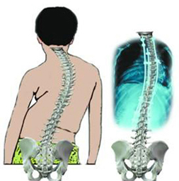 強(qiáng)直性脊柱炎會(huì)遺傳嗎